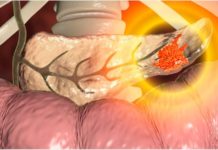 Israël : premier patient traité avec un médicament innovant contre le cancer colorectal