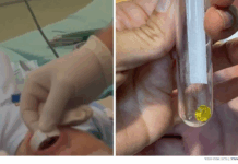 Ashdod : un enfant de trois ans sauvé après avoir avalé une pièce de Lego