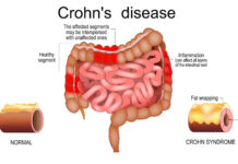 Une simple prise de sang pourrait détecter un risque de maladie de Crohn des années avant les premiers symptômes
