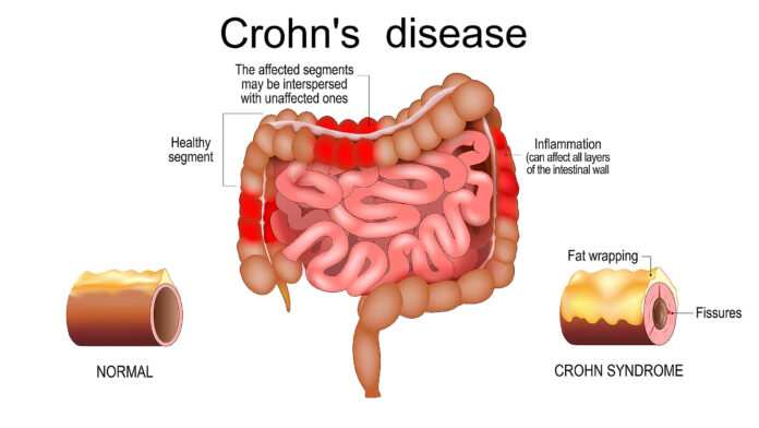 Crohn disease. intestine with Inflammation