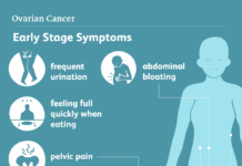 Le cancer de l’ovaire, ce tueur silencieux que personne ne regarde : pourquoi des milliers de femmes sont encore diagnostiquées trop tard