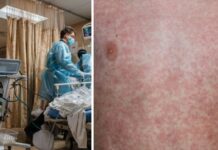 Rougeole dans les abris : le virus profite de la guerre pour se propager